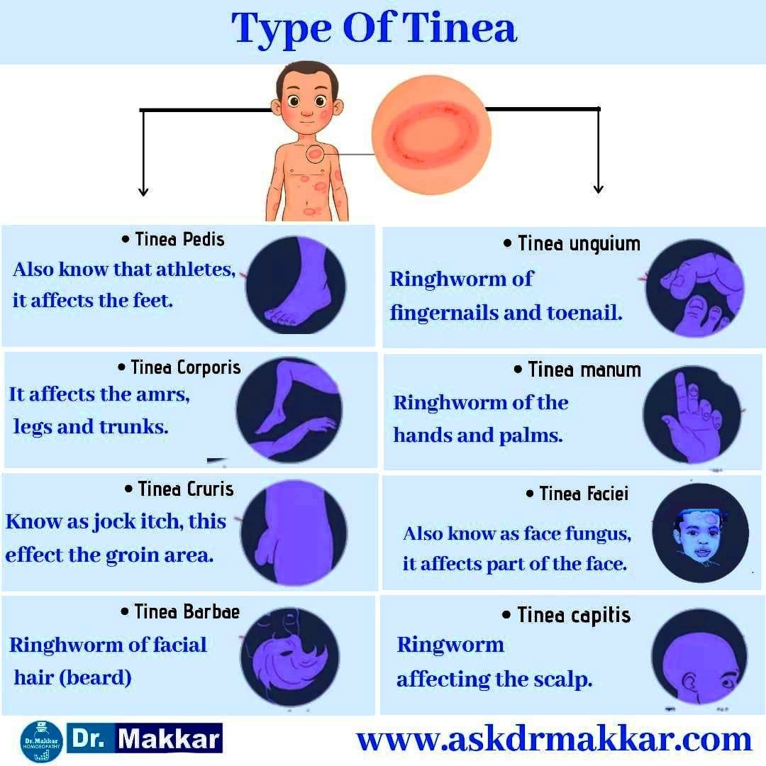 Tinea Ringworm tyes Pictures.j